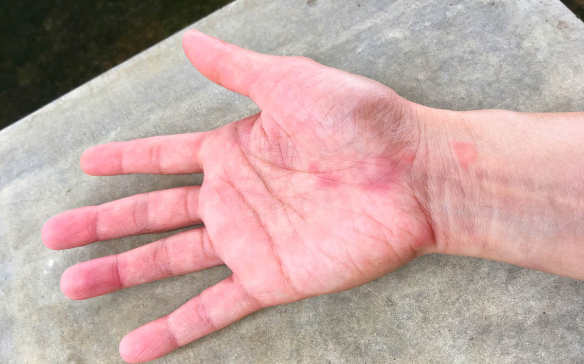 Lupus Cómo ayudar al paciente en la farmacia comunitaria Teva