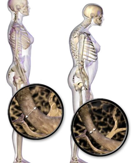 Paciente polimedicado con osteoporosis