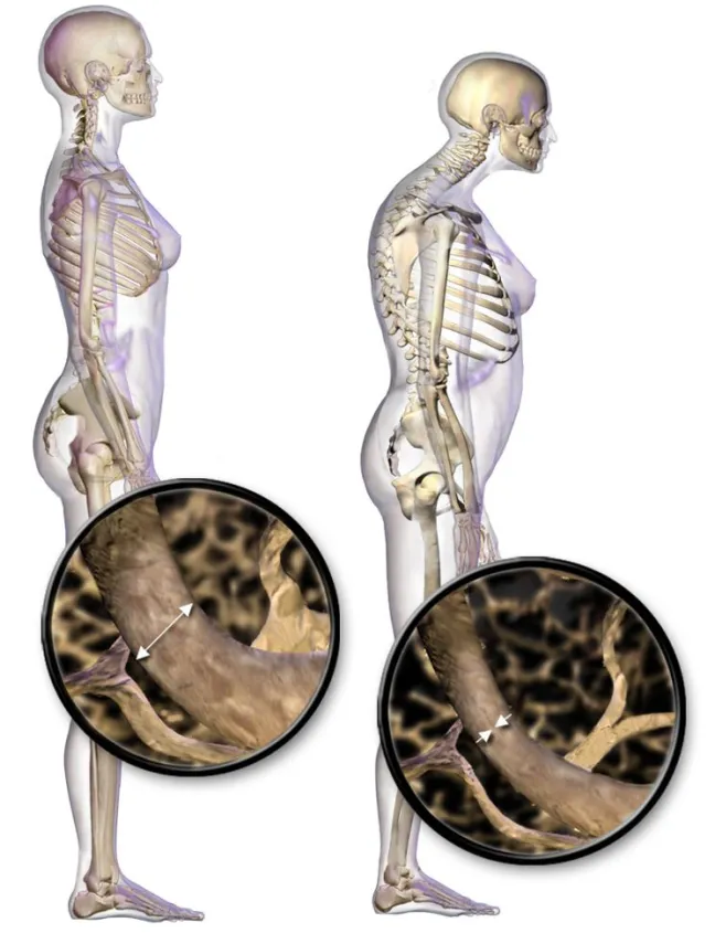 Paciente polimedicado con osteoporosis