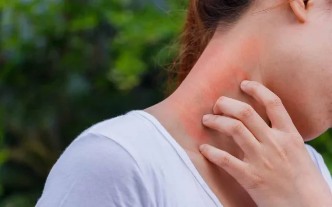 picor en el cuello dermatitis-atopica-cuello